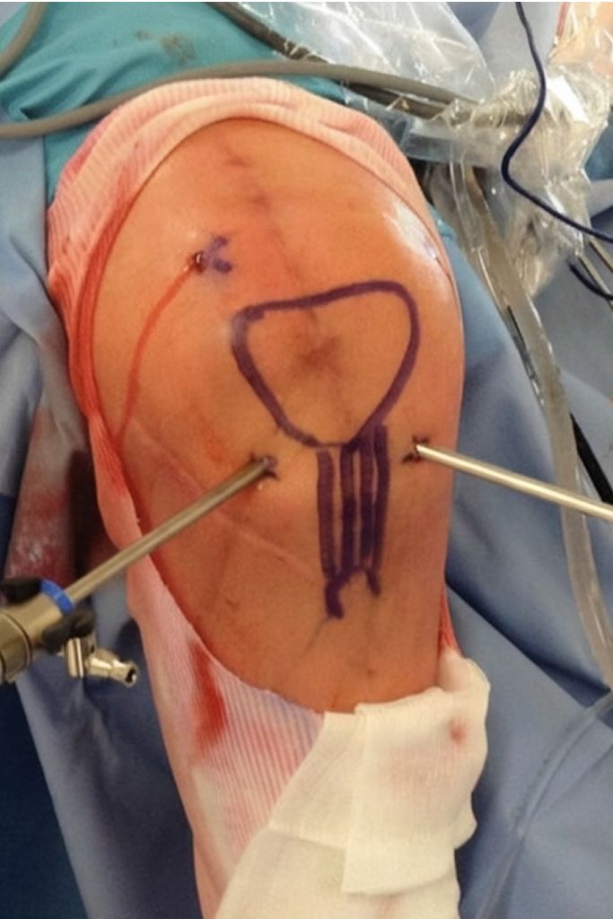 Arthroscopic Knee Surgery | Dr. Soumen Kar