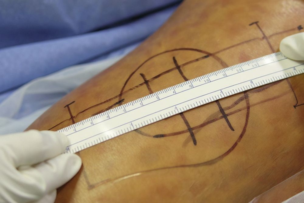 Hip Hemiarthroplasty Surgery Procedure | Dr. Soumen Kar