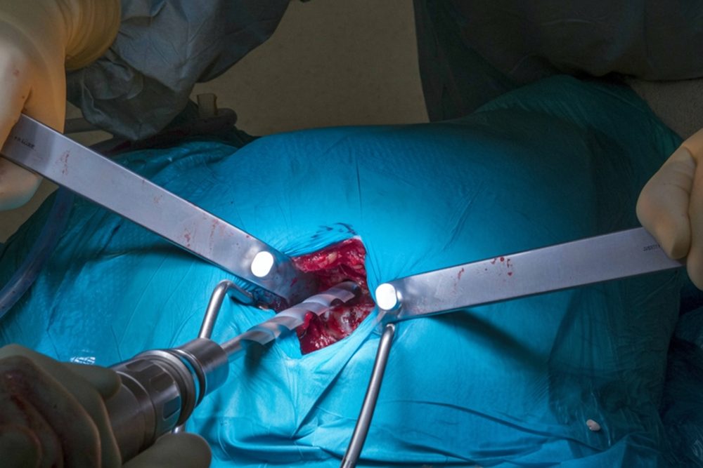 Total Hip Replacement Surgery Procedure | Dr. Soumen Kar