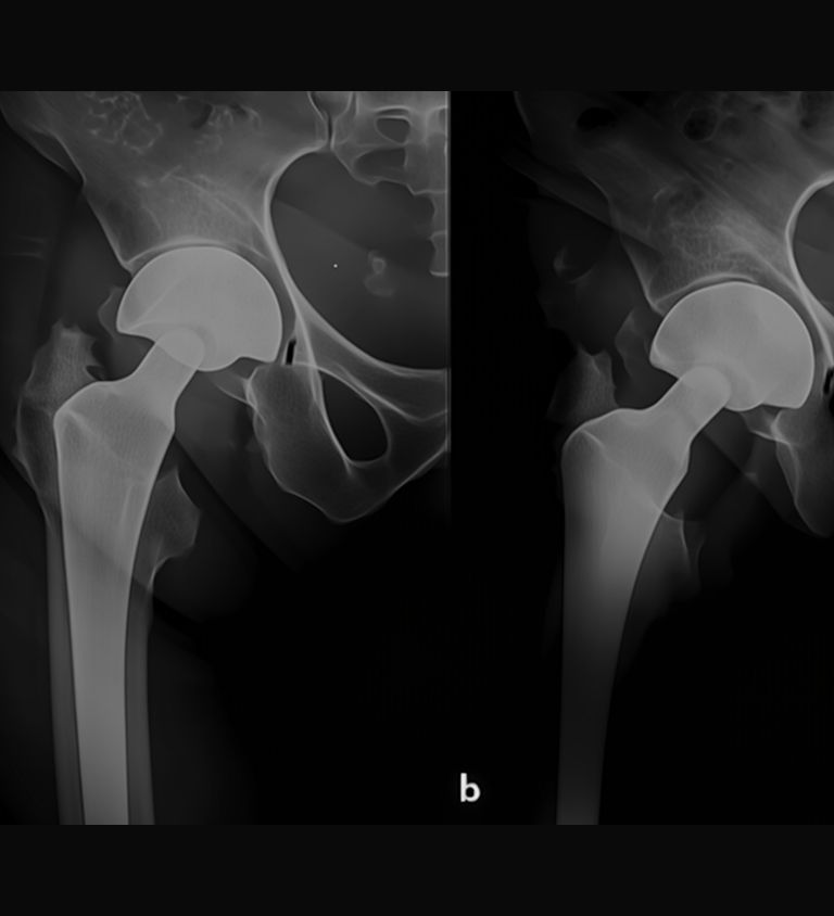 Types of Hip Hemiarthroplasty Surgery | Dr. Soumen Kar